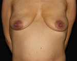 Abdominoplasty - Case #2 Before